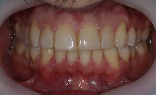 Case 980 before