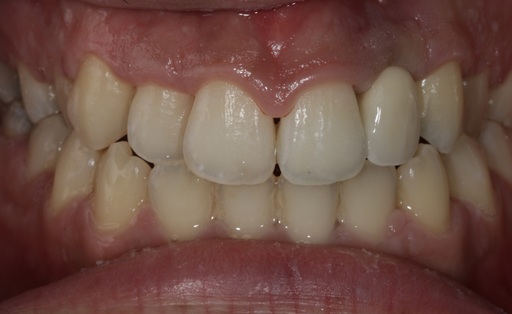 Case 989 after