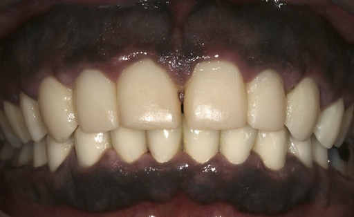 Case 1011 before