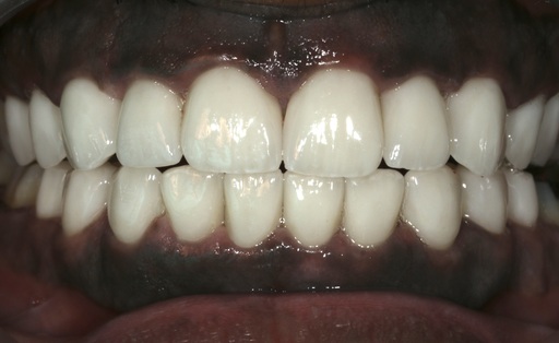 Case 1011 after