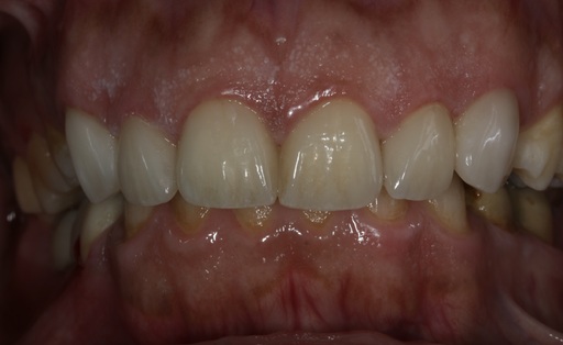 Case 998 after